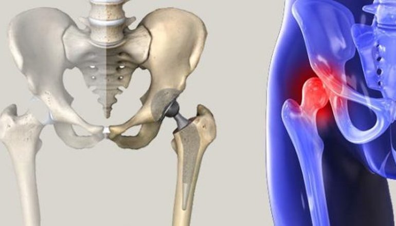 F.A.Q about Hip Osteoarthritis