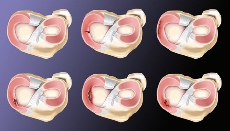 Meniscus Tears and Treatment